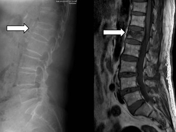 좌측 일반 엑스레이 사진에 요추1번에 압박 골절이 관찰되고
우측 MRI 사진에 같은 부위에 급성 압박골절이 관찰됩니다