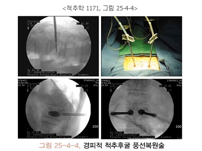 경피적 척추후굴 풍선복원술
