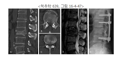 경피적 척추후굴 풍선복원술