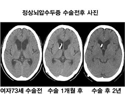 경피적 척추후굴 풍선복원술