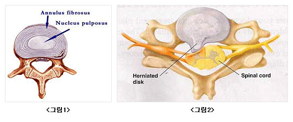 <척추학 932, 글미 20-4-1> / 그림 20-4-1, 남녀 연령에 따른 골량의 변화 / 최대 골량의 형성은 약 30세 전후까지 이루어지며, 이때는 골형성이 골흡수보다 많이 발생하여 골량의 증가가 유지되며, 이러한 골량의 증가는 사춘기 전후에 가장 왕성하게 일어난다. 30~50세 정도까지는 어느 정도 평탄한 소량의 골량 감소를 보이지만 여성은 폐경기에 해당하는 50세 전후에 여성호르몬 결핍으로 골형성보다 골흡수 과정이 향진된 결과로 급작스런 골량의 감소가 발생하게 된다. 유전적으로 남성이 여성보다 최대 골량이 높게 형성되며, 남성은 여성과 같은 급격한 호르몬 변화가 없어 50세 이후에도 비교적 완만한 골감소를 보여 골정의 발생 위험도가 상대적으로 여성에 비해 낮다.